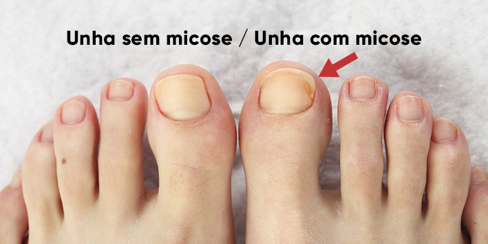 Micose de unha